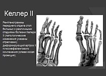 Болезнь Келлера.